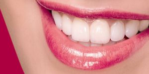 Răng sứ TiTan là gì ?
