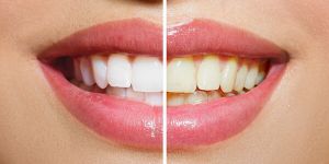 Giá tẩy trắng răng bằng công nghệ laser whitening