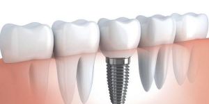 Cắm răng Implant
